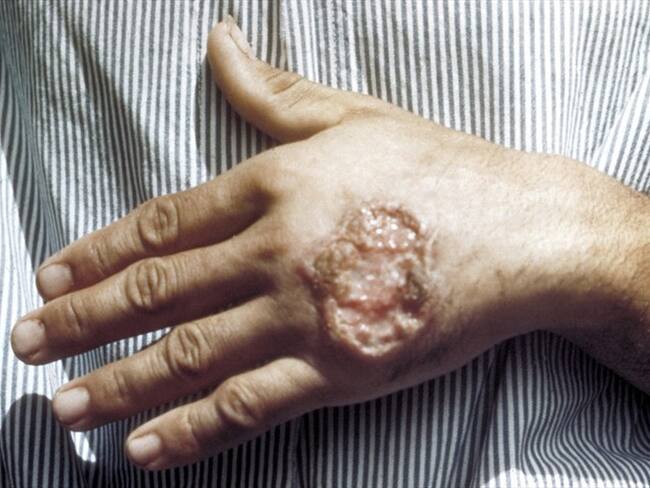 Universidad de Antioquia creó un tratamiento patentado contra la Leishmaniasis