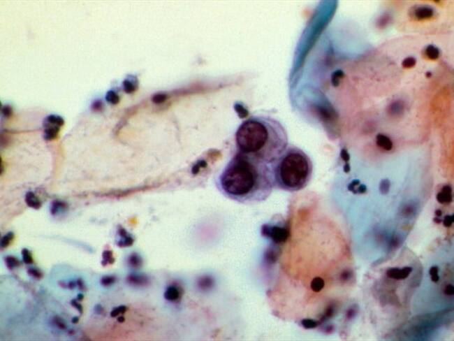 La investigación que permitiría transformar células cancerígenas en grasa